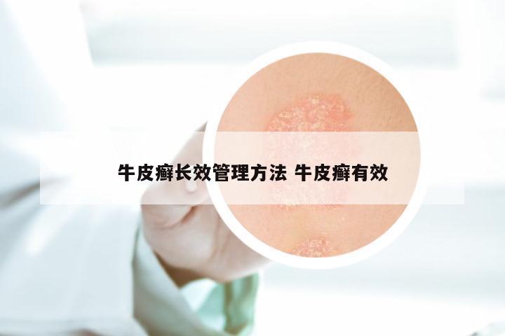 牛皮癣长效管理方法 牛皮癣有效