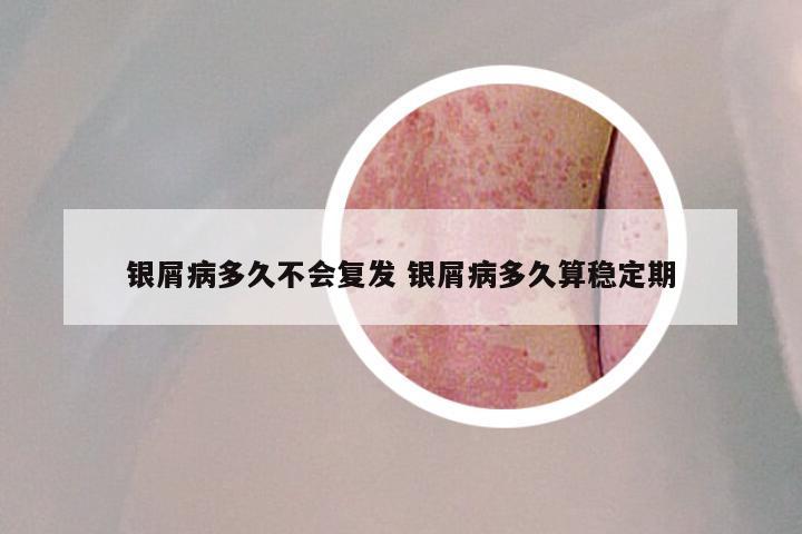 银屑病多久不会复发 银屑病多久算稳定期