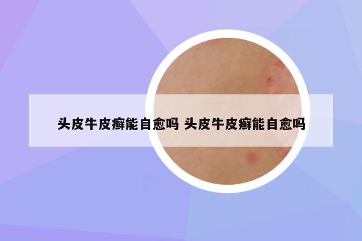 头皮牛皮癣能自愈吗 头皮牛皮癣能自愈吗