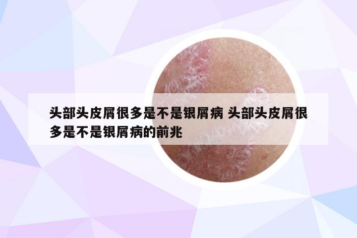头部头皮屑很多是不是银屑病 头部头皮屑很多是不是银屑病的前兆