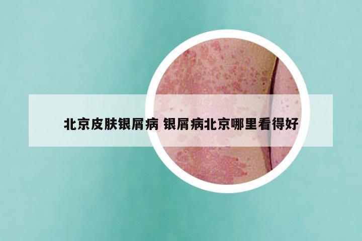 北京皮肤银屑病 银屑病北京哪里看得好