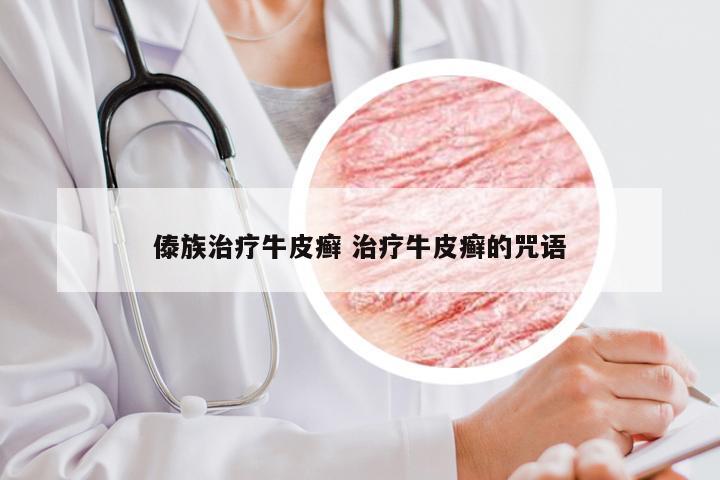 傣族治疗牛皮癣 治疗牛皮癣的咒语