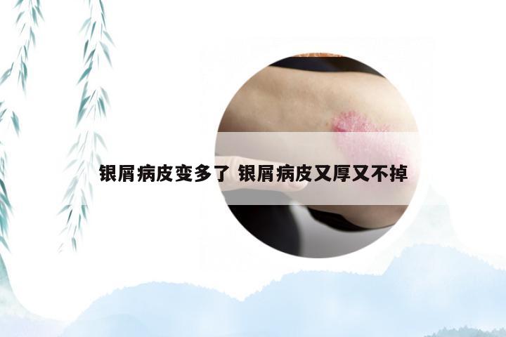 银屑病皮变多了 银屑病皮又厚又不掉