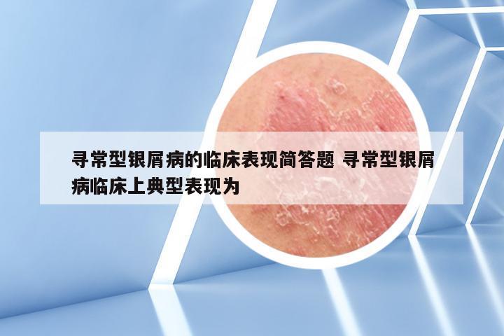 寻常型银屑病的临床表现简答题 寻常型银屑病临床上典型表现为