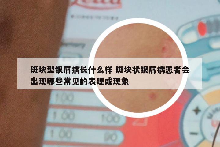 斑块型银屑病长什么样 斑块状银屑病患者会出现哪些常见的表现或现象