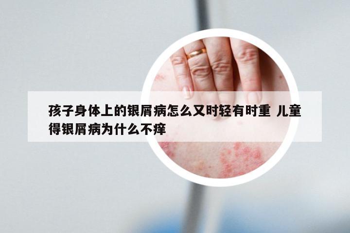 孩子身体上的银屑病怎么又时轻有时重 儿童得银屑病为什么不痒
