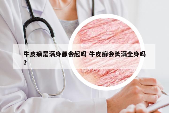 牛皮癣是满身都会起吗 牛皮癣会长满全身吗?