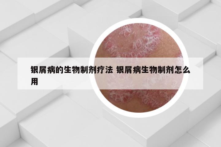 银屑病的生物制剂疗法 银屑病生物制剂怎么用