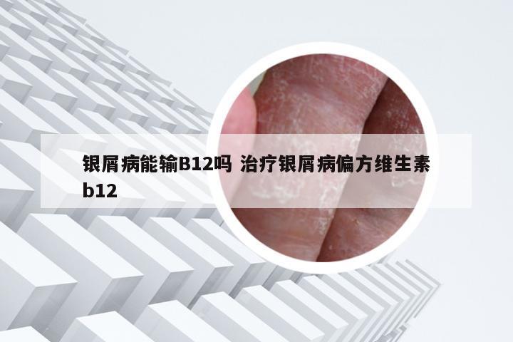 银屑病能输B12吗 治疗银屑病偏方维生素b12