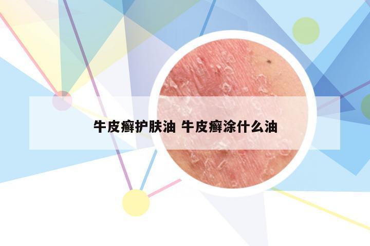 牛皮癣护肤油 牛皮癣涂什么油