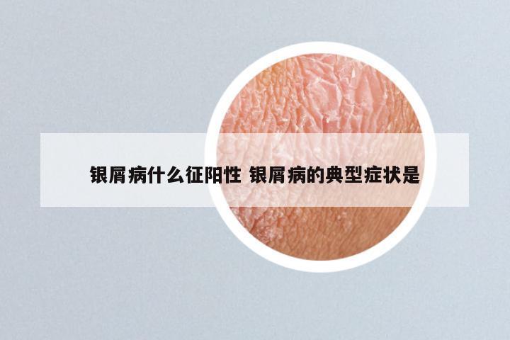 银屑病什么征阳性 银屑病的典型症状是