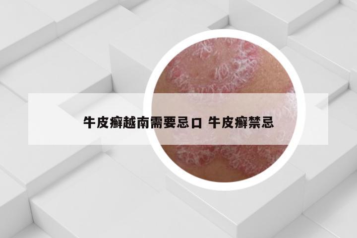 牛皮癣越南需要忌口 牛皮癣禁忌