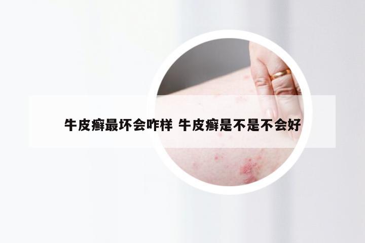牛皮癣最坏会咋样 牛皮癣是不是不会好
