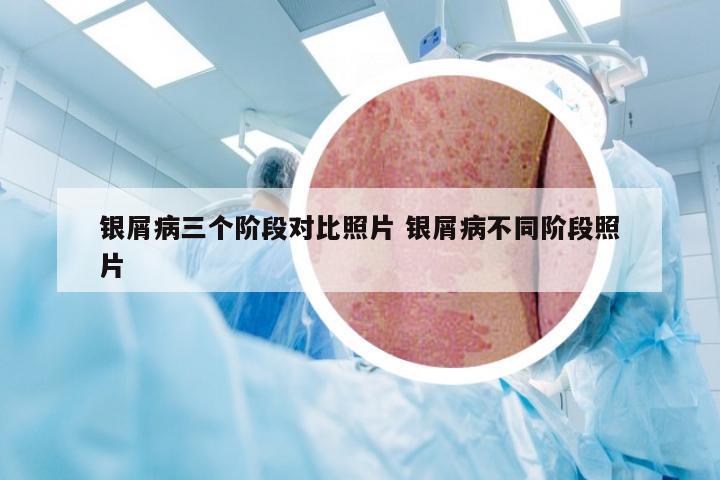 银屑病三个阶段对比照片 银屑病不同阶段照片