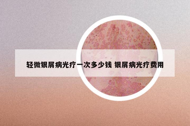 轻微银屑病光疗一次多少钱 银屑病光疗费用