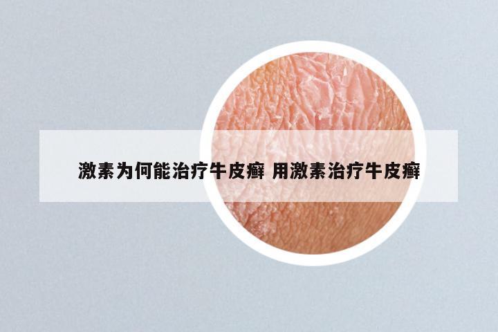 激素为何能治疗牛皮癣 用激素治疗牛皮癣