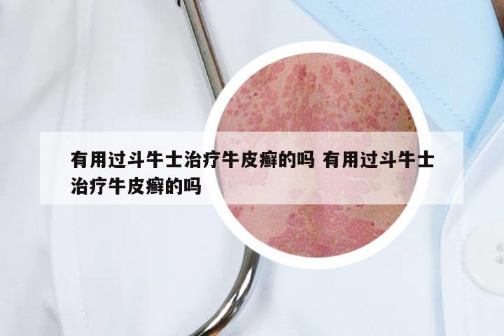 有用过斗牛士治疗牛皮癣的吗 有用过斗牛士治疗牛皮癣的吗