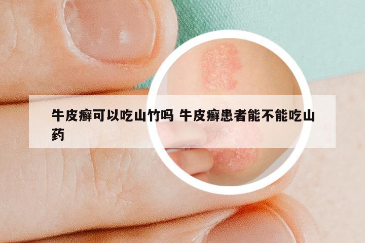 牛皮癣可以吃山竹吗 牛皮癣患者能不能吃山药