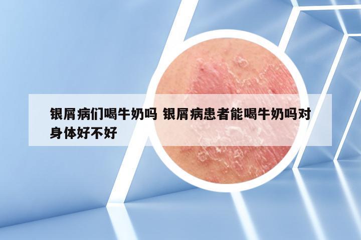 银屑病们喝牛奶吗 银屑病患者能喝牛奶吗对身体好不好