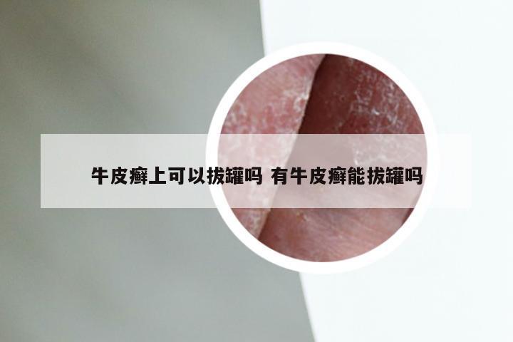 牛皮癣上可以拔罐吗 有牛皮癣能拔罐吗