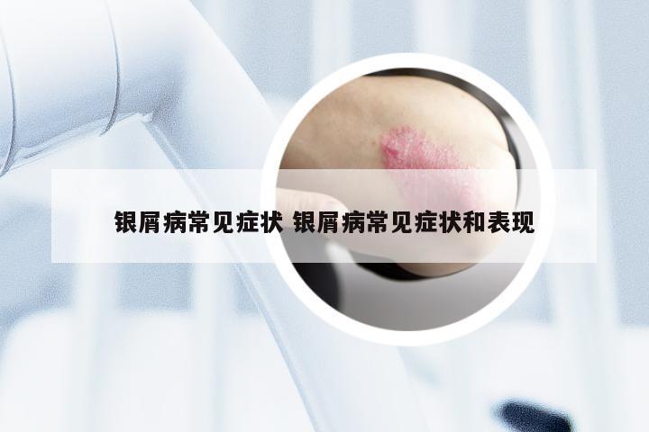 银屑病常见症状 银屑病常见症状和表现