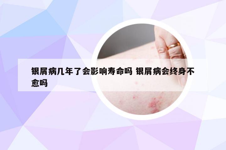 银屑病几年了会影响寿命吗 银屑病会终身不愈吗