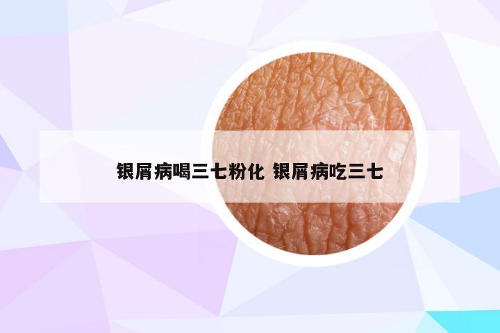 银屑病喝三七粉化 银屑病吃三七
