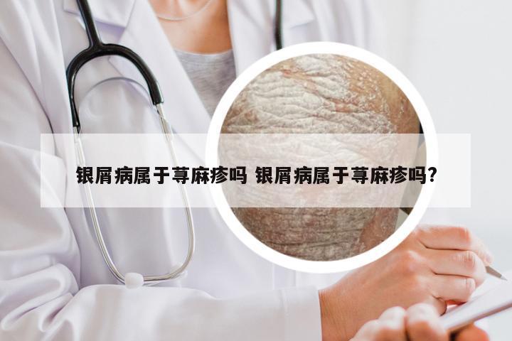 银屑病属于荨麻疹吗 银屑病属于荨麻疹吗?