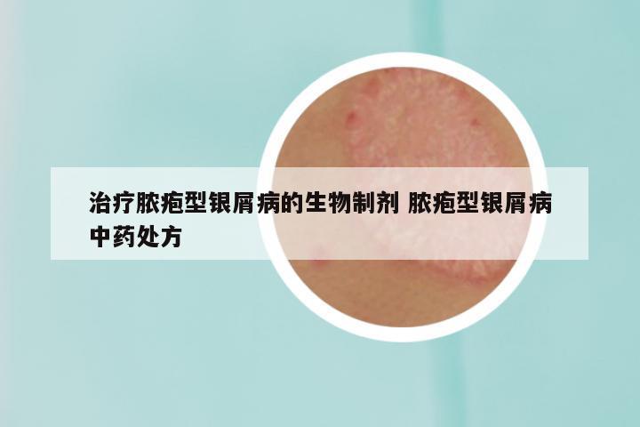 治疗脓疱型银屑病的生物制剂 脓疱型银屑病中药处方