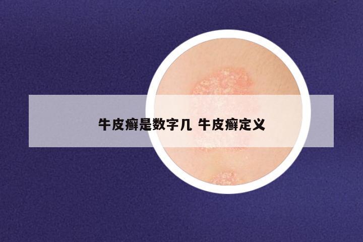 牛皮癣是数字几 牛皮癣定义