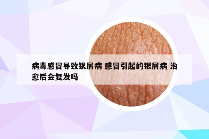病毒感冒导致银屑病 感冒引起的银屑病 治愈后会复发吗