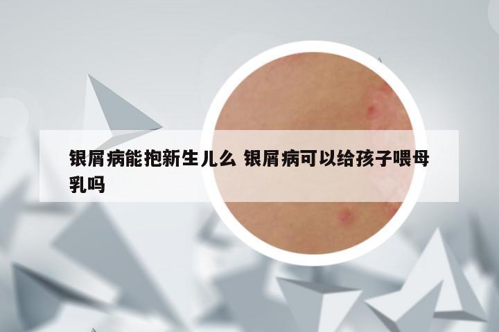 银屑病能抱新生儿么 银屑病可以给孩子喂母乳吗