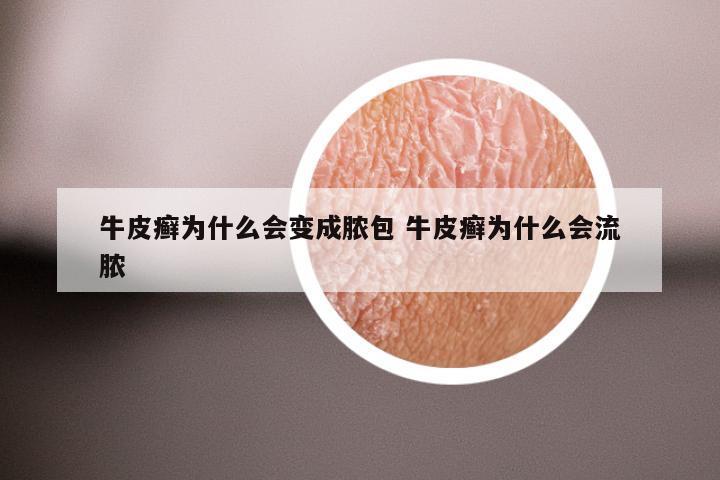牛皮癣为什么会变成脓包 牛皮癣为什么会流脓