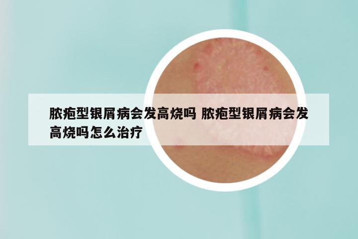 脓疱型银屑病会发高烧吗 脓疱型银屑病会发高烧吗怎么治疗