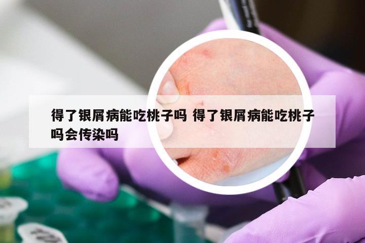得了银屑病能吃桃子吗 得了银屑病能吃桃子吗会传染吗