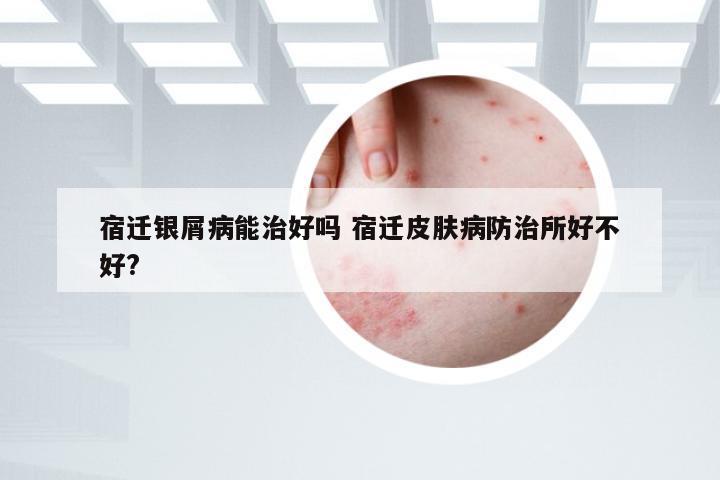 宿迁银屑病能治好吗 宿迁皮肤病防治所好不好?