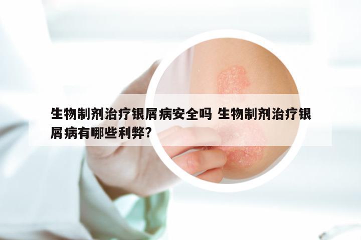 生物制剂治疗银屑病安全吗 生物制剂治疗银屑病有哪些利弊?