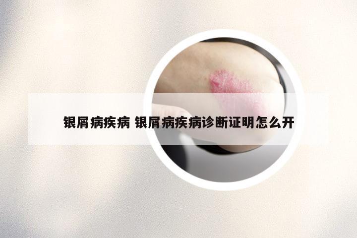 银屑病疾病 银屑病疾病诊断证明怎么开