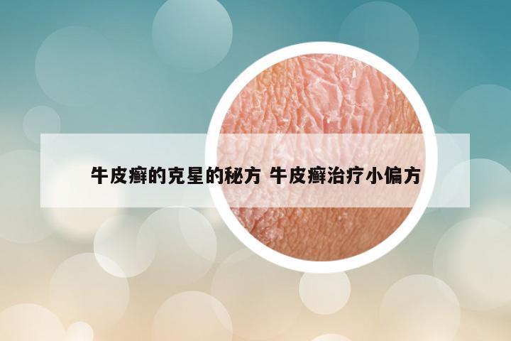牛皮癣的克星的秘方 牛皮癣治疗小偏方