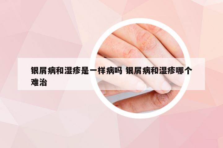 银屑病和湿疹是一样病吗 银屑病和湿疹哪个难治