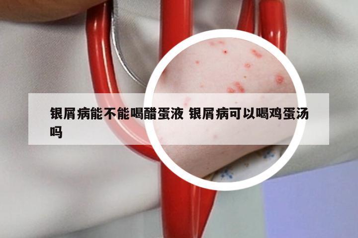 银屑病能不能喝醋蛋液 银屑病可以喝鸡蛋汤吗