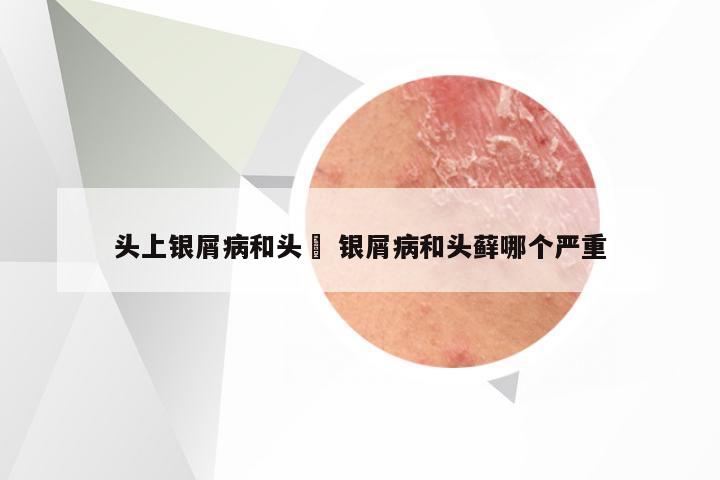 头上银屑病和头廯 银屑病和头藓哪个严重