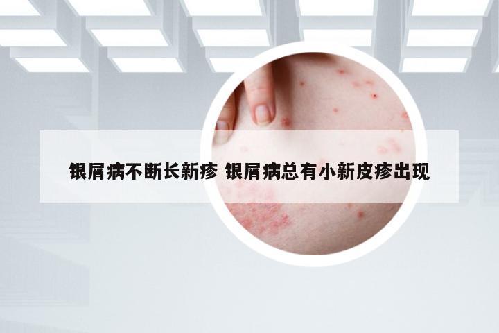 银屑病不断长新疹 银屑病总有小新皮疹出现
