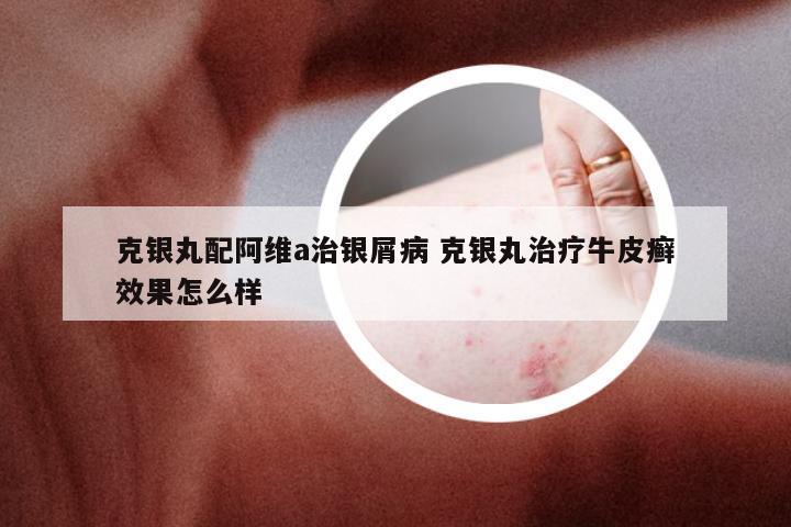 克银丸配阿维a治银屑病 克银丸治疗牛皮癣效果怎么样