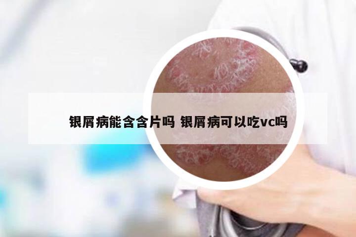 银屑病能含含片吗 银屑病可以吃vc吗