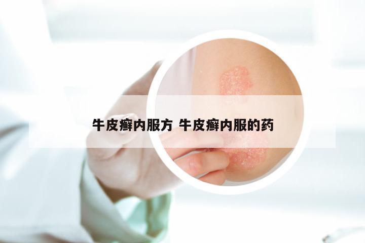 牛皮癣内服方 牛皮癣内服的药