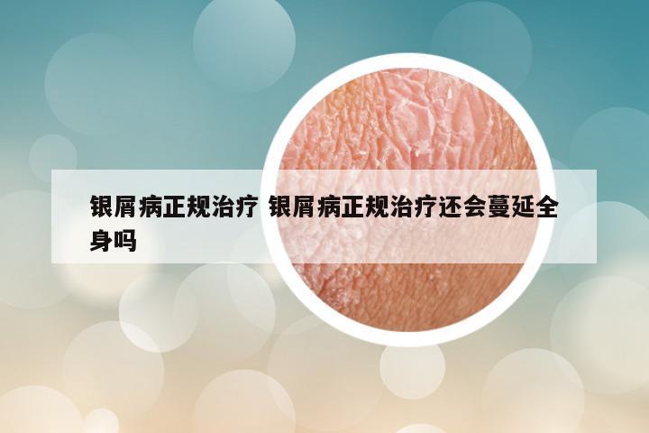 银屑病正规治疗 银屑病正规治疗还会蔓延全身吗