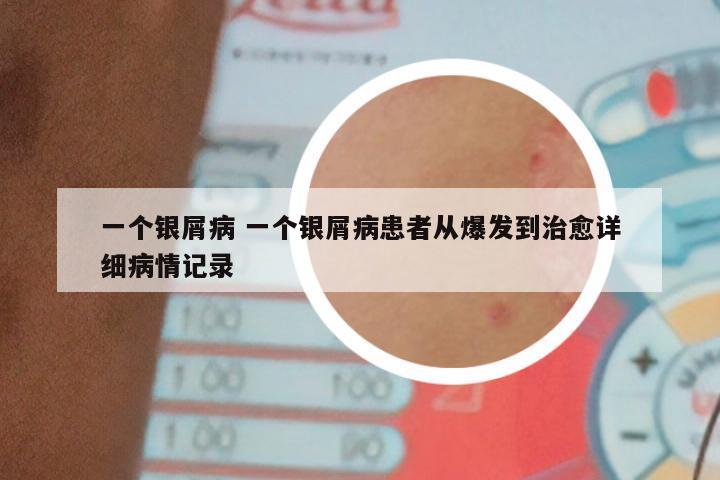 一个银屑病 一个银屑病患者从爆发到治愈详细病情记录