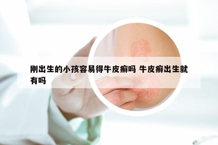 刚出生的小孩容易得牛皮癣吗 牛皮癣出生就有吗