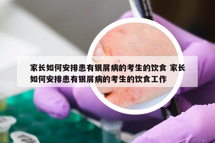 家长如何安排患有银屑病的考生的饮食 家长如何安排患有银屑病的考生的饮食工作